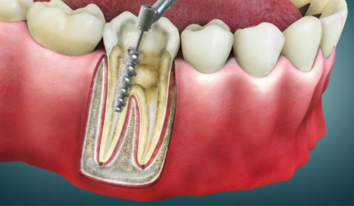 Painless Root Canal